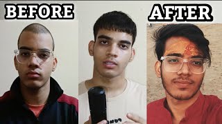REVERSE Your HAIRLOSS || How to Stop Hair fall in Men || How to fix male pattern baldness @chadtag