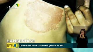 Hanseníase: o que é, sintomas, transmissão e tem cura? - Minha Vida