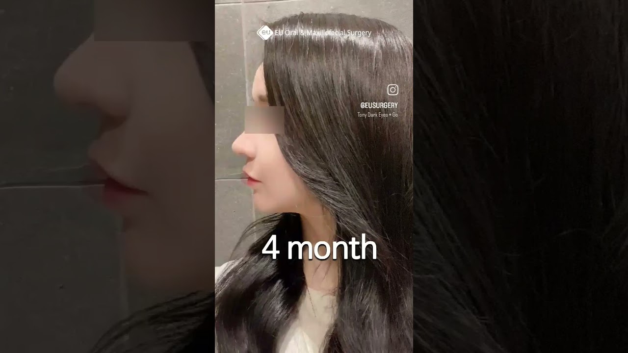 Korean Double Jaw Surgery + V-Line Surgery Results | (Before & After)