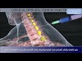 حقن إلتهاب والشد العضلي في الرقبة بواسطة مضاد الالتهاب بالإبر تحت الاشعة التداخلية