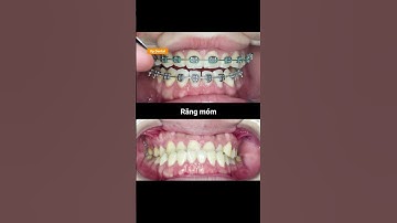 Cận cảnh quá trình thay đổi răng móm