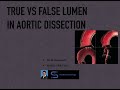 True vs False Lumen of Aortic dissection