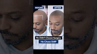 Scalp Micropigmentation NYC | Real SMP Procedure at SMP Masters