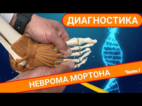 НЕВРОМА МОРТОНА: что это и как диагностировать? (Часть 1)