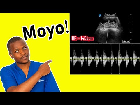 Video: Je, unaweza kucheza moyo kwa mara ya kwanza?