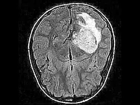 Brain Tumour Detection using Deep Learning