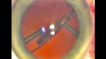 Repositioning of dislocated IOL with optic capture in anterior capsulorhexis  - Dr Simon Chen