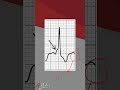 Mastering ECG Interpretation Wolff Parkinson White Syndrome Type A Explained For Medical Students Mastering ECG Interpretation Wolff Parkinson White Syndrome Type A Explained For Medical Students