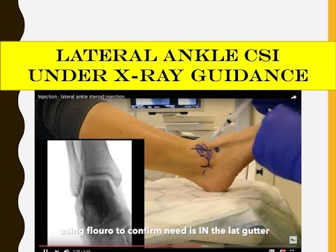 Injection - lateral ankle steroid injection