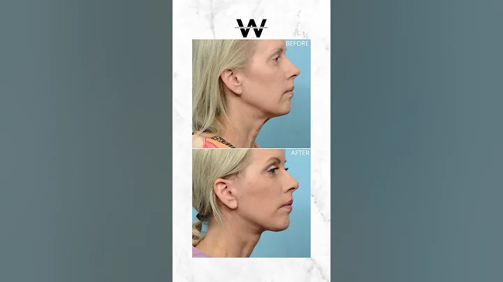 I performed a deep plane facelift on this patient to reverse the signs of aging. #facelift