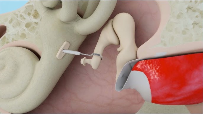 Middle Ear Bone Total Replacement - Total Ossicular Replacement Prosthesis  (TORP) for Hearing Loss - YouTube