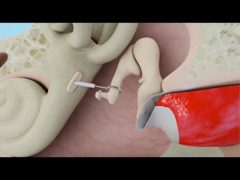 Stapedotomy Animation to Treat Otosclerosis (Curable Type of Hearing Loss)