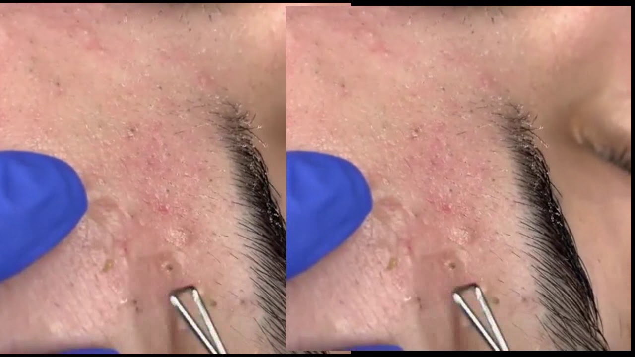 Dr Pimple Popper Blackhead Extraction Youtube