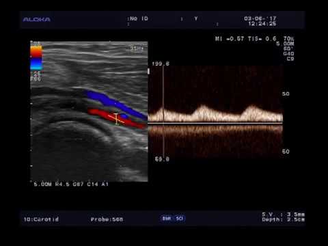 Окклюзия НПА - коллатеральный кровоток в ПКА