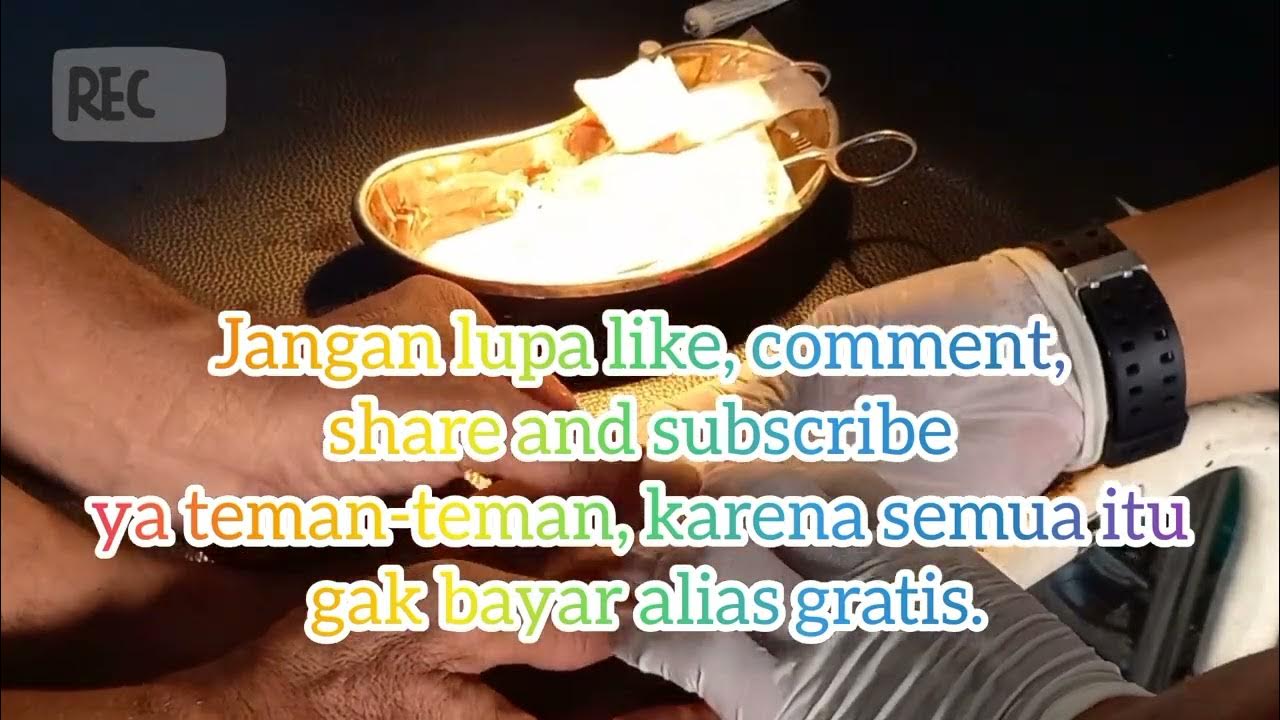 Ketahui Penyebab dan Cara Mengatasi Cantengan Jempol Kaki/Proses