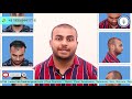 I-FUE Hair Transplant Technique || Hairfree & Hairgrow Clinic Surat Branch || Best Review