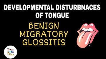 DEVELOPMENTAL DISTURBANCES OF TONGUE- BENIGN MIGRATORY GLOSSITIS