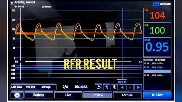 FFR & RFR FOR MODERATE LESION OF MID LAD