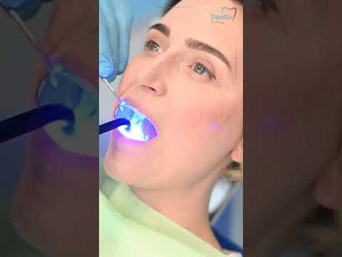 Video: Šta je zubni inlay?