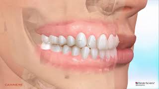 Animation Motion Clear with Clear Aligners for non erupted cuspids