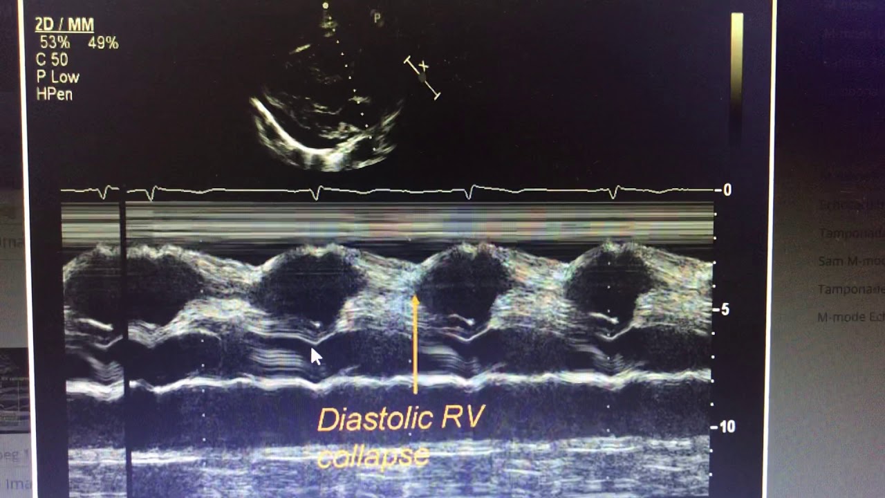 M mode in cardiac tamponade YouTube