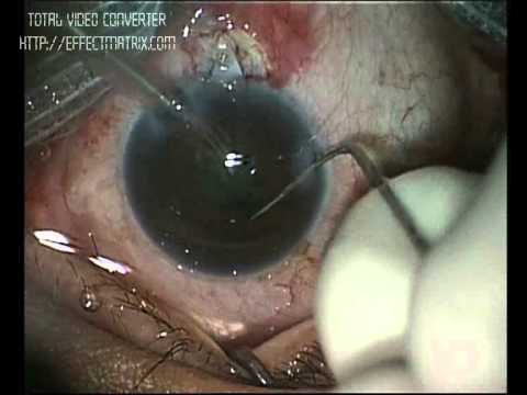 Vidéo: Implantation De Microstent Hydrus Pour La Prise En Charge Chirurgicale Du Glaucome: Un Examen De La Conception, De L'efficacité Et De La Sécurité