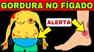 9 SINAIS de GORDURA no FÍGADO | Quais Sintomas de Fígado Doente?