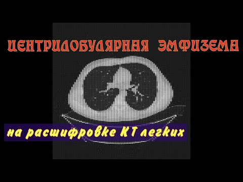 ЦЕНТРИЛОБУЛЯРНАЯ ЭМФИЗЕМА   множественные КИСТЫ в легких на КТ РАСШИФРОВКЕ