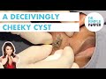 A Deceivingly Cheeky Cyst