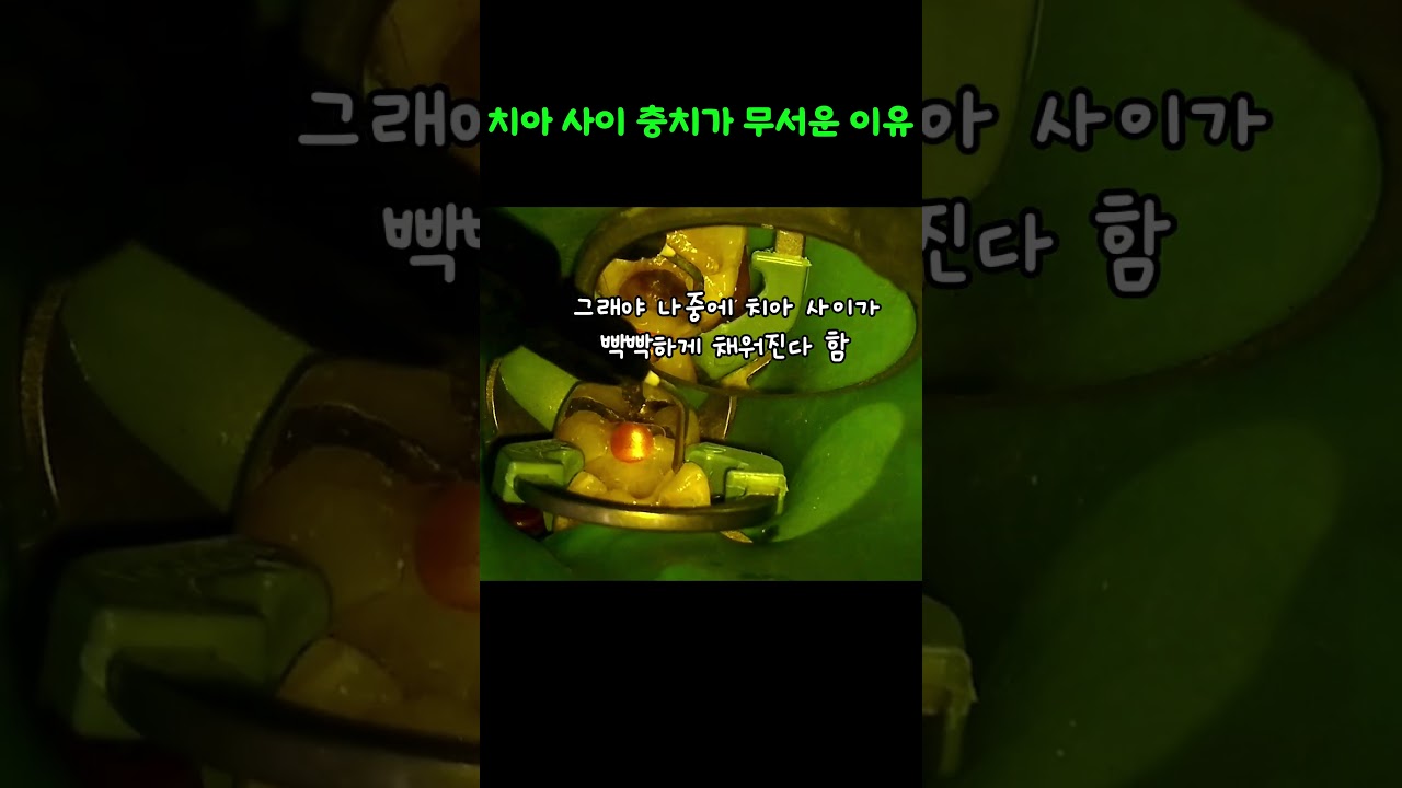 치아사이 충치가 돈 많이 드는 이유... 맞닿아있는 치아까지 썩어있을 확률 높음..