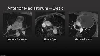 Approach to Mediastinal Masses screenshot 3