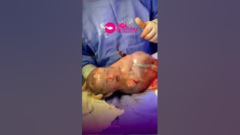Médico rompe a bolsa amniótica do bebê com o dedo - Parto Empelicado