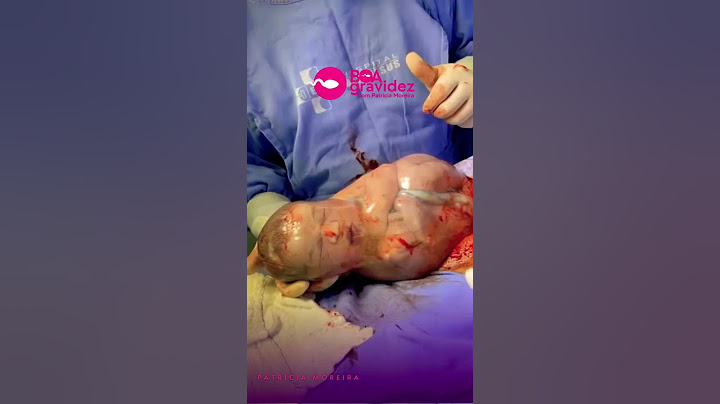 Médico rompe a bolsa amniótica do bebê com o dedo - Parto Empelicado