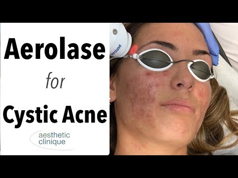 Aerolase for Cystic Acne