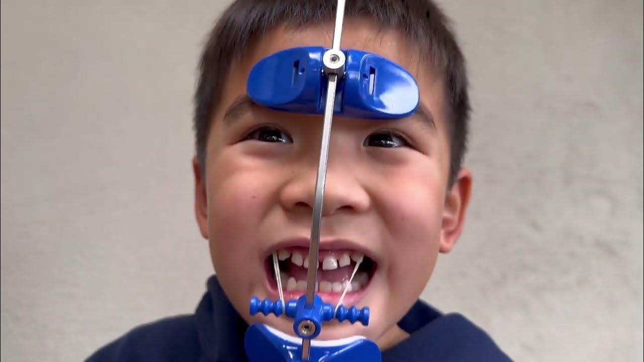 Ryder’s Underbite Treatment Journey Orthodontic TreatmentHeadgear Day