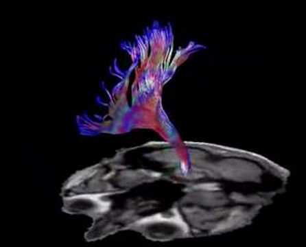 Brain Fiber Tractography
