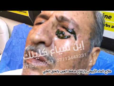علاج الماء الأبيض وارتفاع ضغط العين بالعلق الطبي