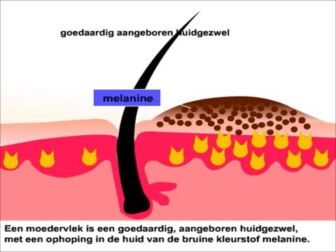 Video: Is Het Gevaarlijk Als Een Moedervlek Pijn Doet?