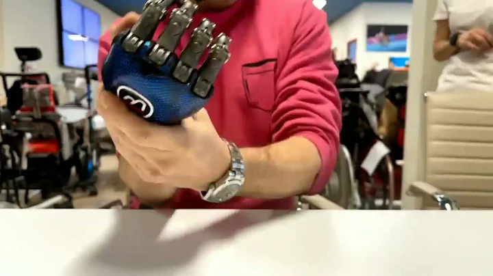 Point Designs Patient Tries on Titanium Prosthetic Fingers!