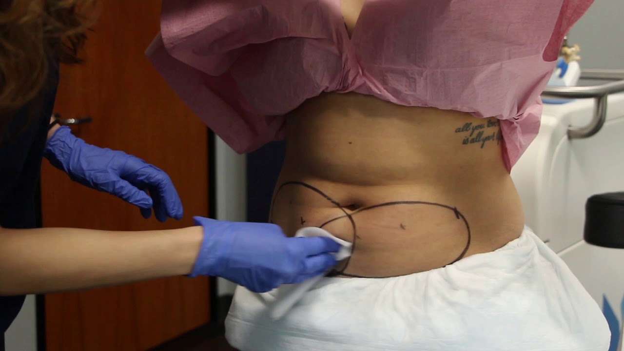Banner for CoolSculpting by Dr. Boen