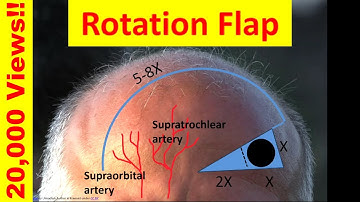 How to design a rotation flap