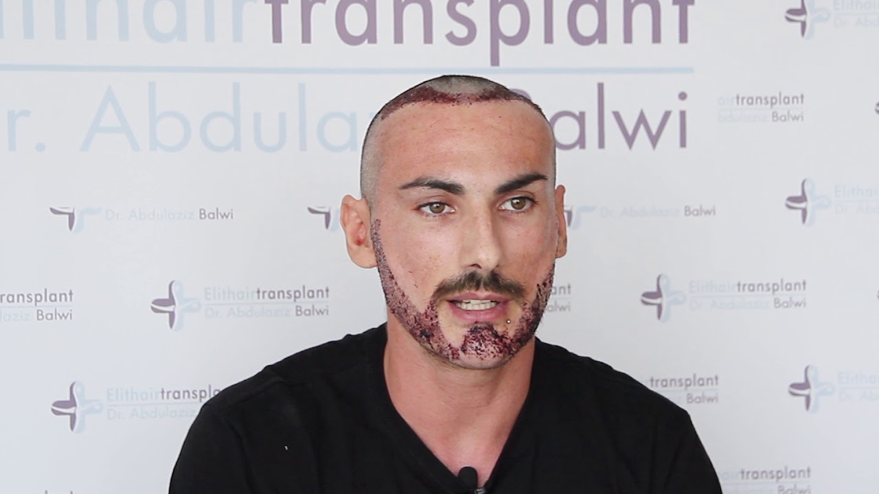 Trapianto di capelli e barba Istanbul - Elithairtransplant e dr. Balwi