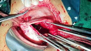 Cesarean Delivery Of A Post Cs Patient