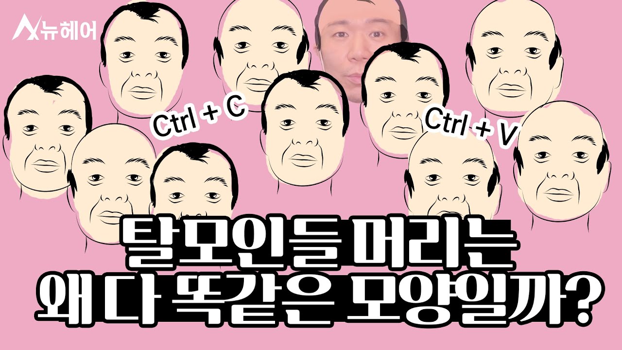 탈모 오면 앞머리, 정수리부터 빠지는 이유!?ㅣ뉴헤어