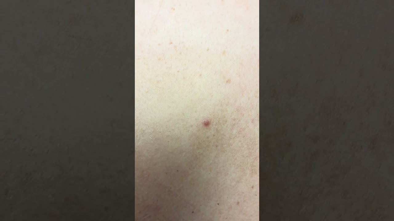 Dr. B shows moles on patient's back 