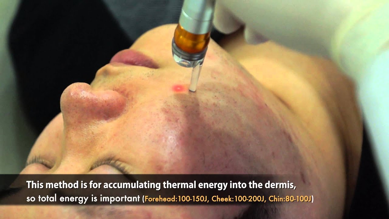 SungJi meditech / Acure laser treatment videos