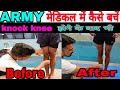 आर्मी मेडिकल में कैसे बचे Knock knee  होने के बावजूद भी  जानिए आसान तरीका