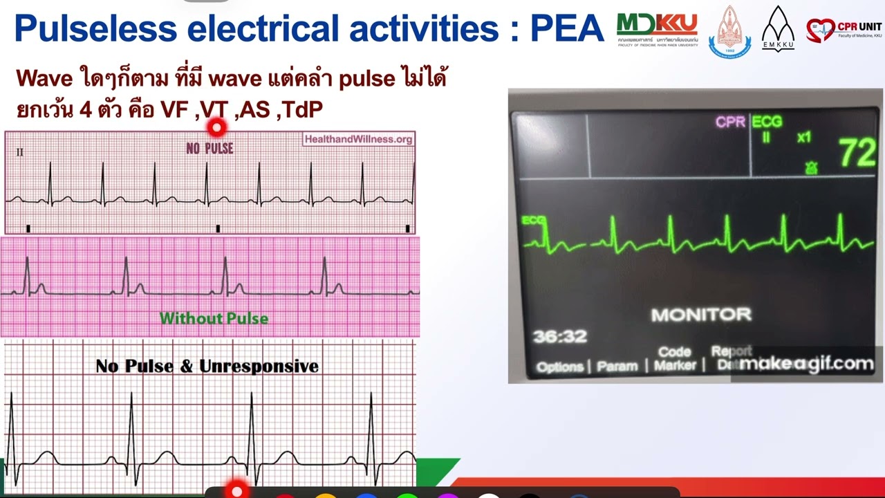 Pulseless Electrical Activity (PEA)