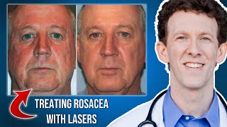 How Can Lasers Help Rosacea?