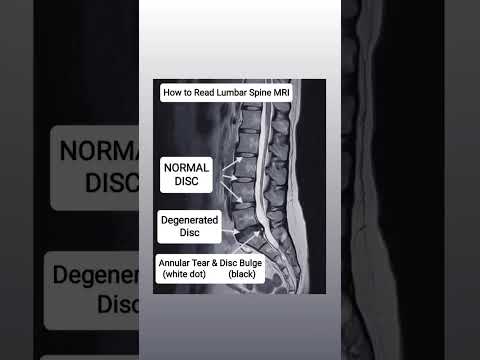 Видео: Бүсэлхий нурууны MRI -ийн хэвийн ба хэвийн бус үр дүнг хэрхэн уншиж, таних вэ